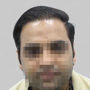 repair hair transplant