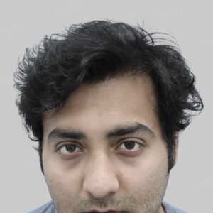 wrong hair transplant