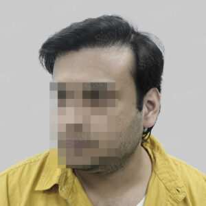 repair hair transplant
