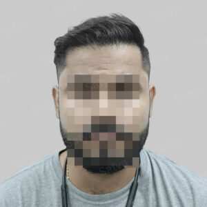 wrong hair transplant