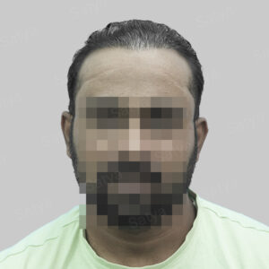 wrong hair transplant