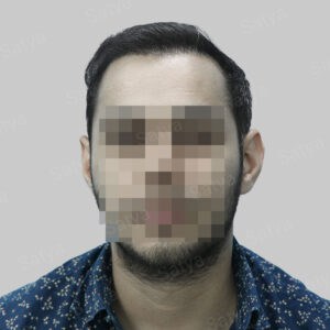 corrective hair transplant