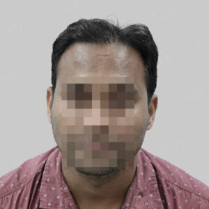 repair hair transplant