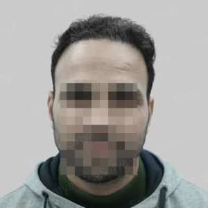 repair hair transplant