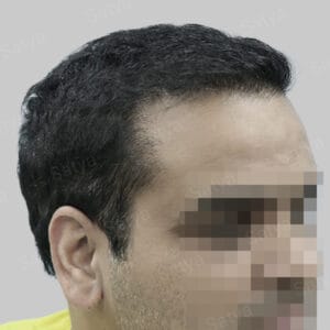 wrong hair transplant