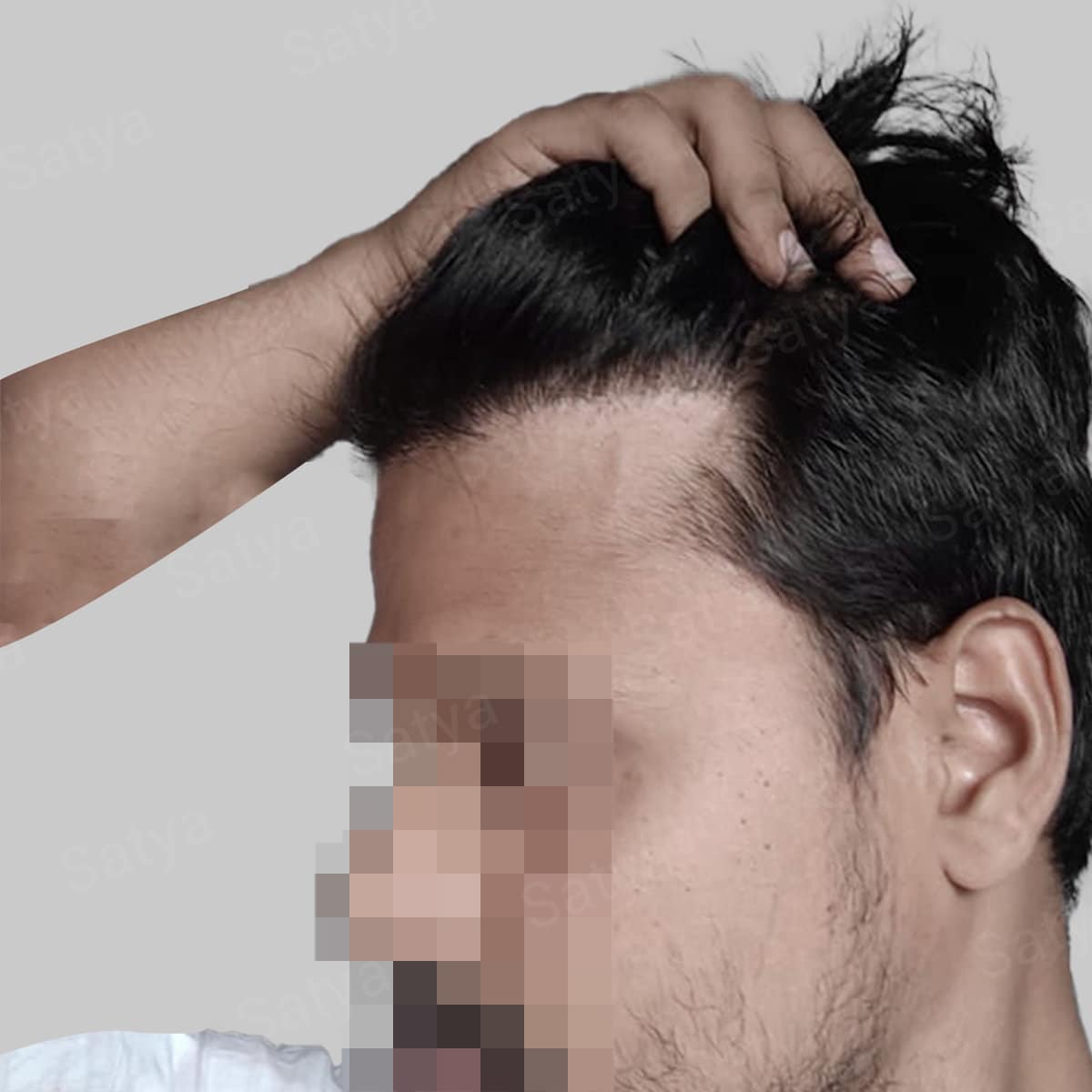 repair hair transplant