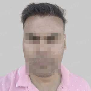 wrong hair transplant