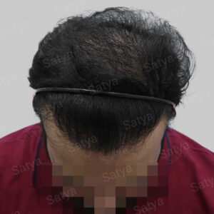 corrective hair transplant