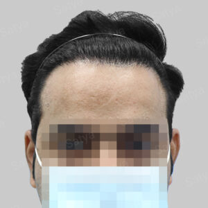corrective hair transplant result
