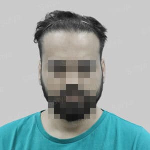 repair hair transplant