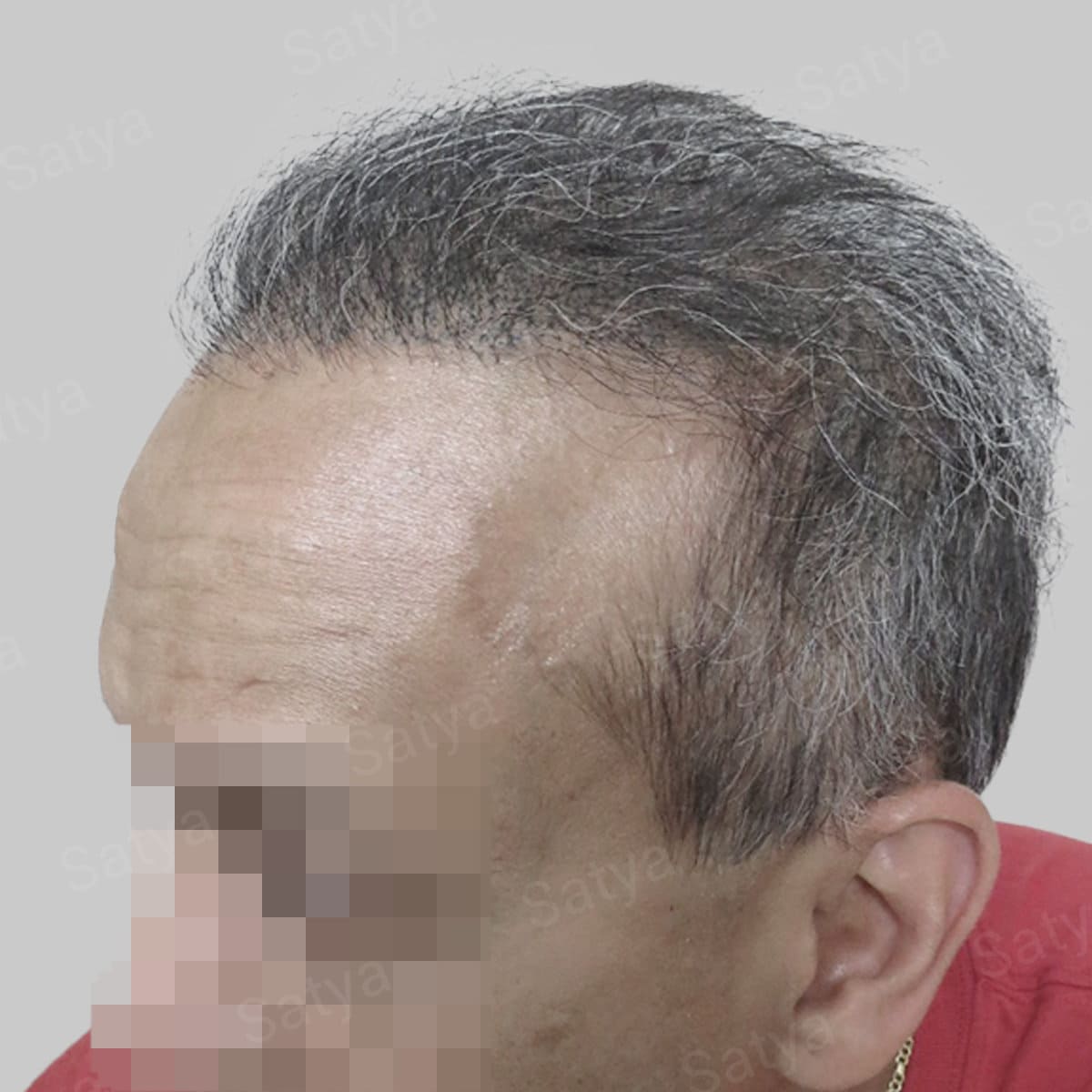 repair hair transplant