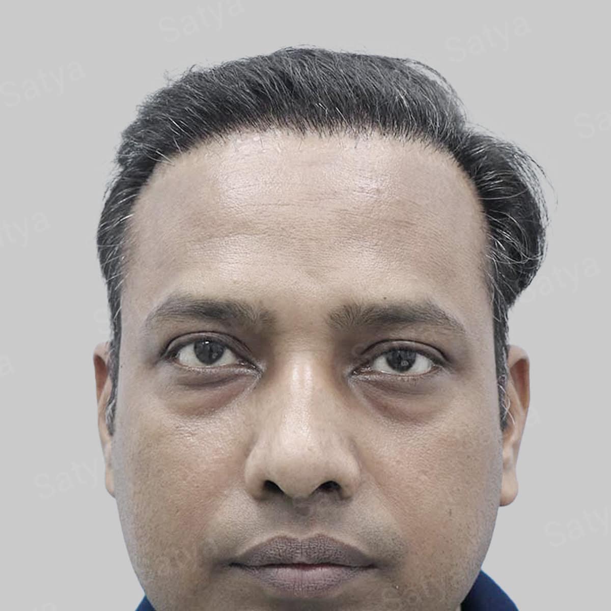 repair hair transplant