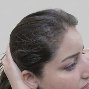 female hair transplant