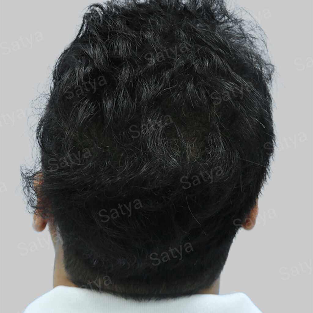 fue hair transplant