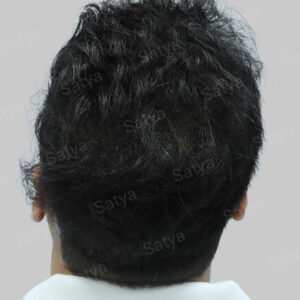 fue hair transplant