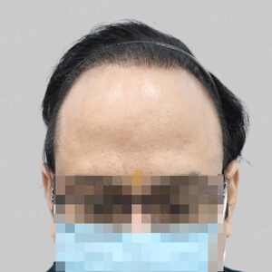 synthetic hair transplant