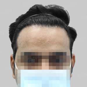 repair hair transplant result
