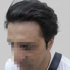 wrong hair line repair