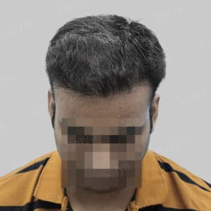 wrong hair transplant
