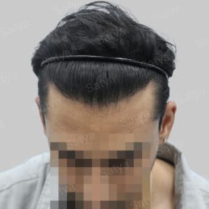 repair hair transplant
