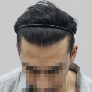 repair hair transplant