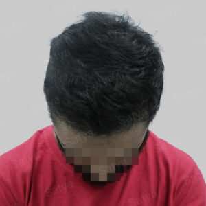 repair hair transplant result in India