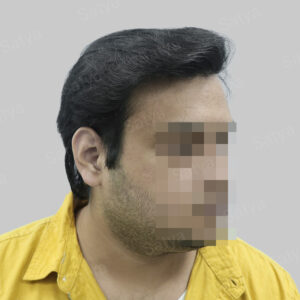 repair hair transplant