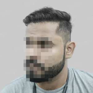 wrong hair transplant