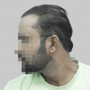wrong hair transplant