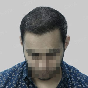 corrective hair transplant