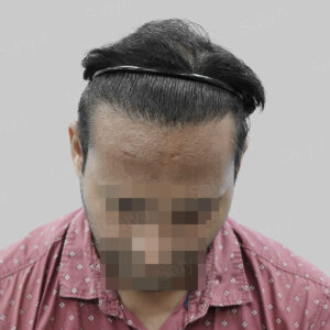 repair hair transplant