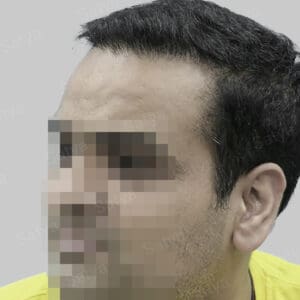 wrong hair transplant