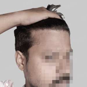 repair hair transplant