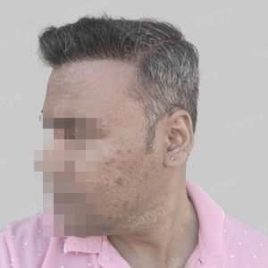 wrong hair transplant