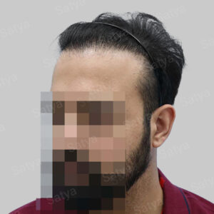 corrective hair transplant
