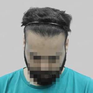 repair hair transplant