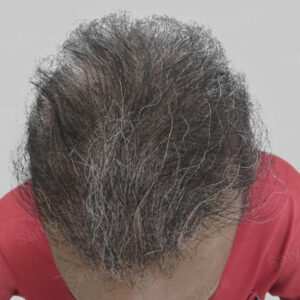 repair hair transplant