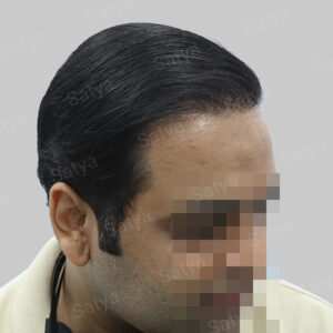 corrective hair transplant