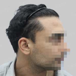 repair hair transplant