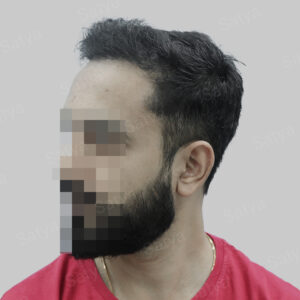 repair hair transplant result in India