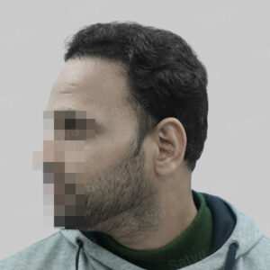 repair hair transplant
