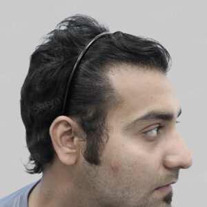 wrong hair transplant