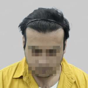 repair hair transplant