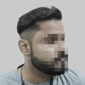 wrong hair transplant