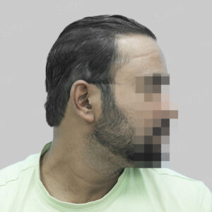 wrong hair transplant