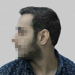 corrective hair transplant