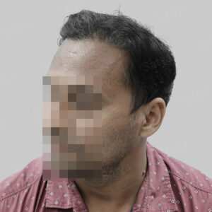 repair hair transplant