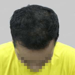 wrong hair transplant