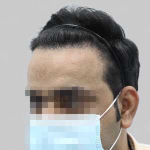 repair hair transplant result