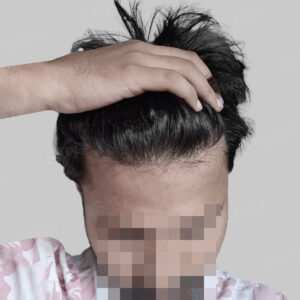 repair hair transplant